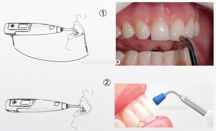 Denjoy MeteEndo Dental Endo Integrated System (with Meta Fill/Meta Pex/Meta Motor/Meta Pulp/Meta Pack)